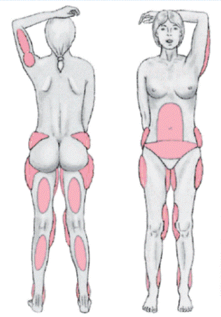 Liposuction Zones